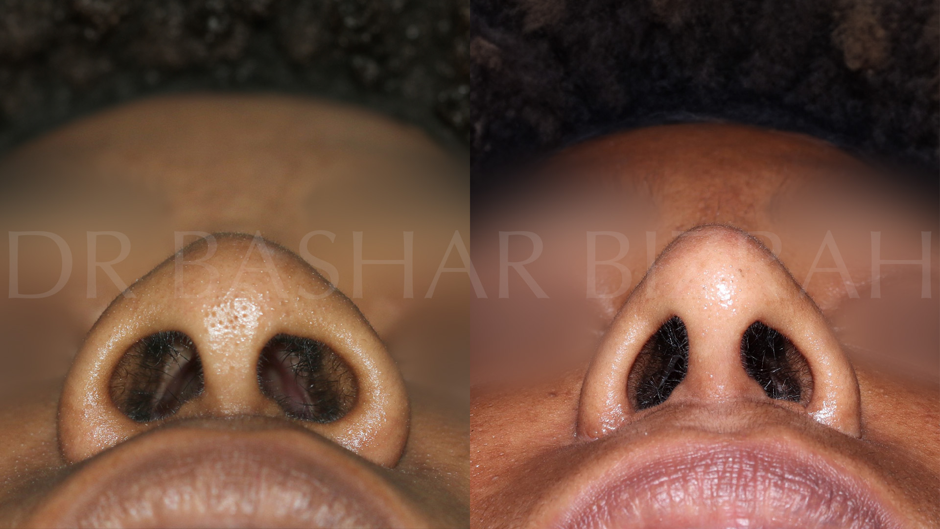 African Rhinoplasty (1)