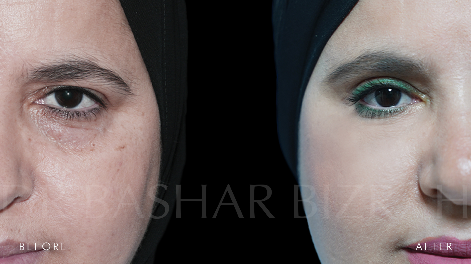 Blepharoplasty (1)