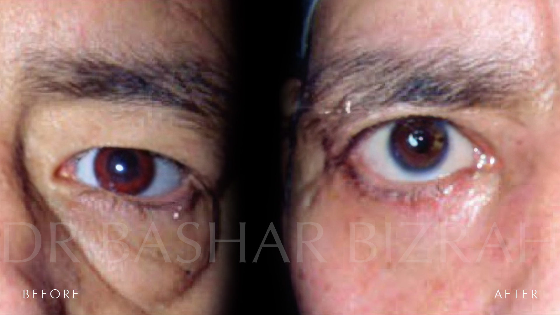 Blepharoplasty (2)