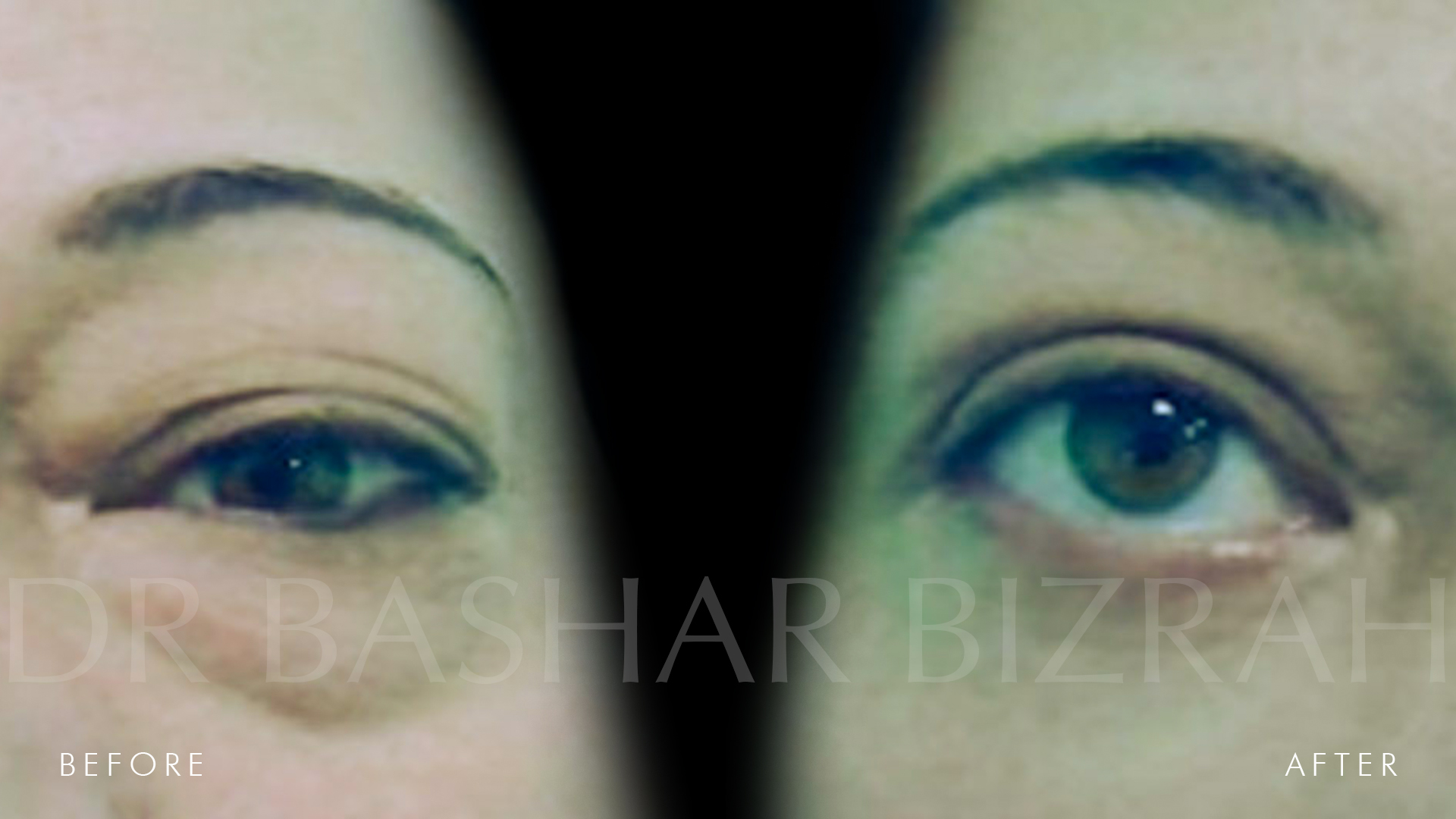 Blepharoplasty (3)
