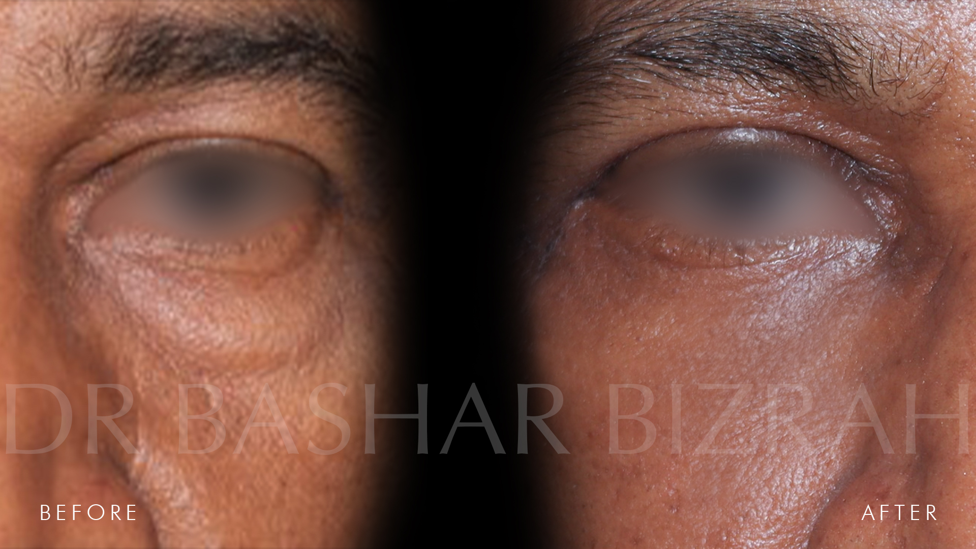 Blepharoplasty (4)