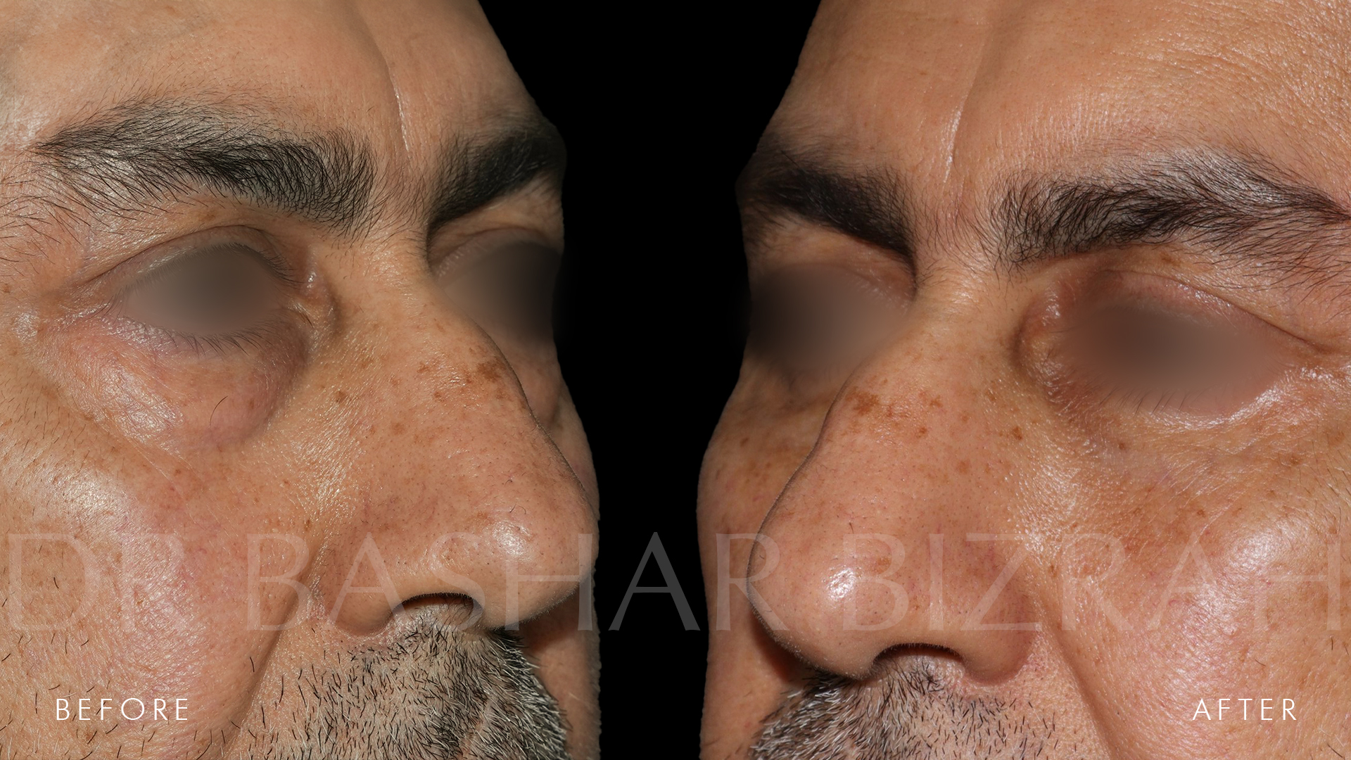 Blepharoplasty (5)