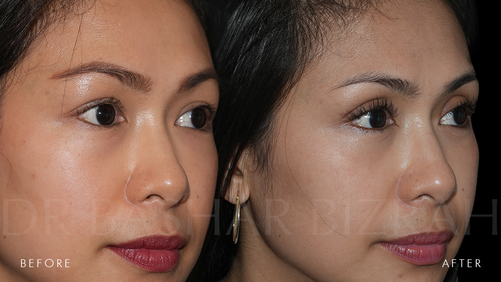 Blepharoplasty (6)