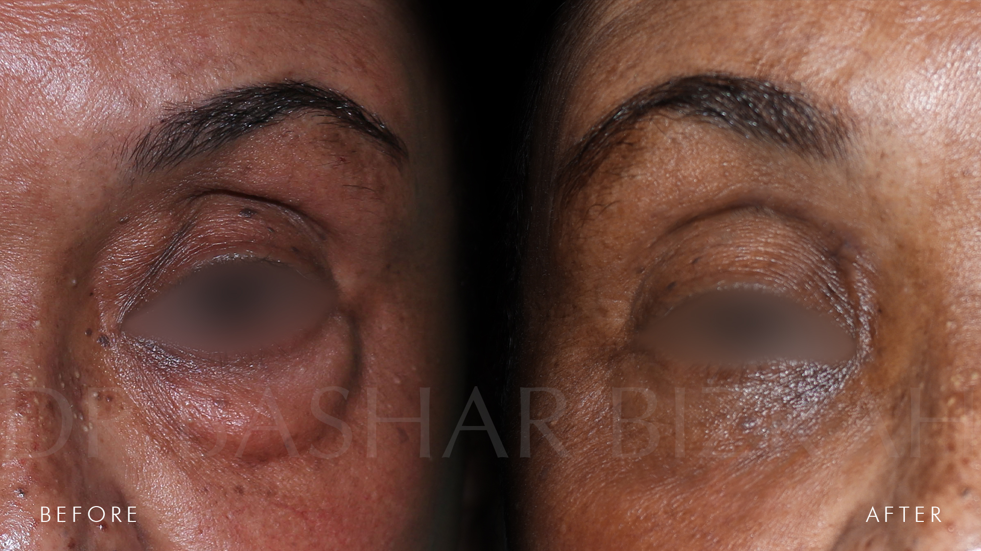 Blepharoplasty (7)