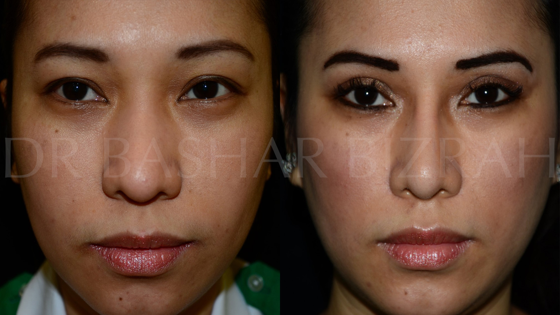 Chinese_Rhinoplasty