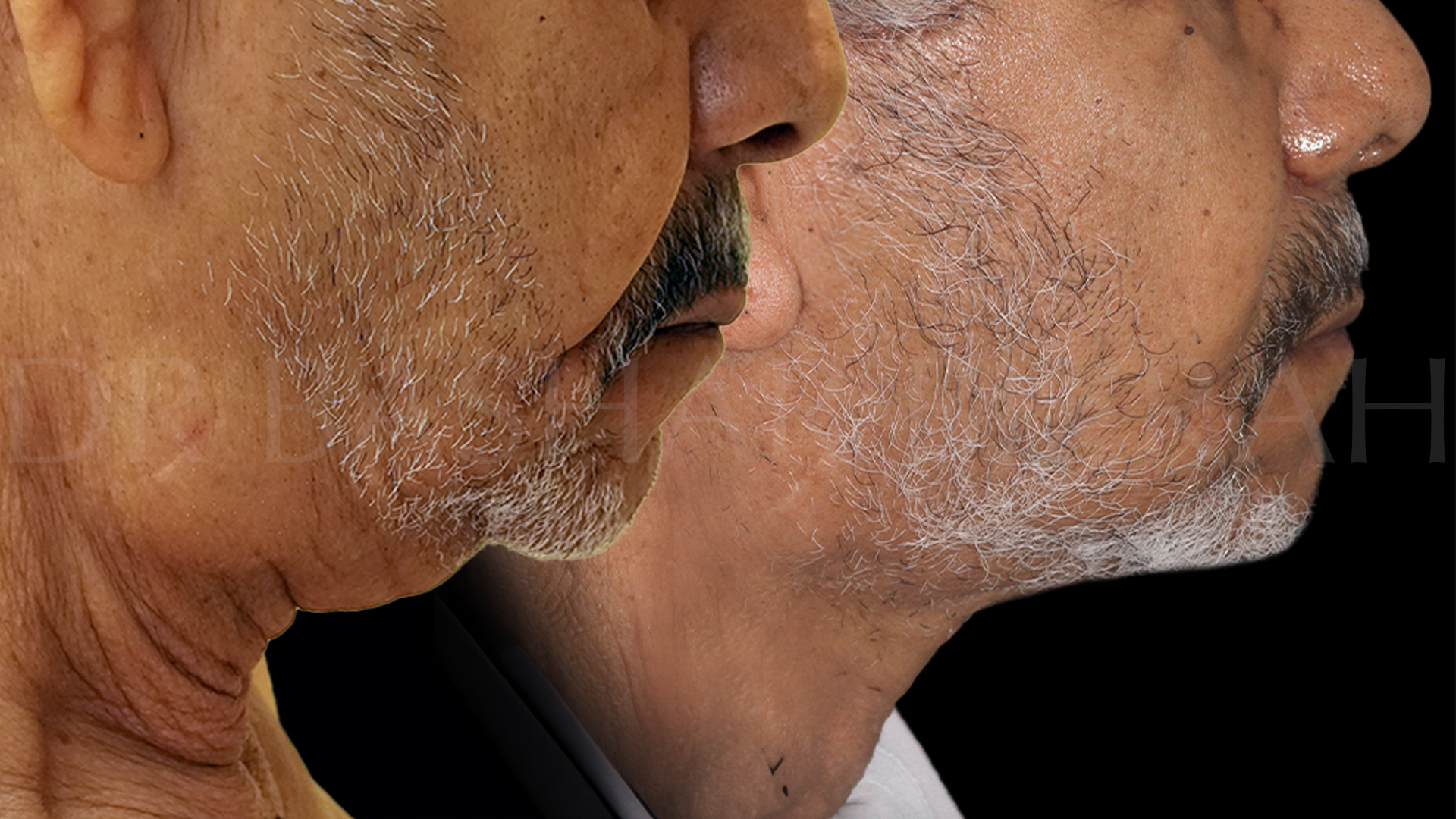Facelift B&A (1)