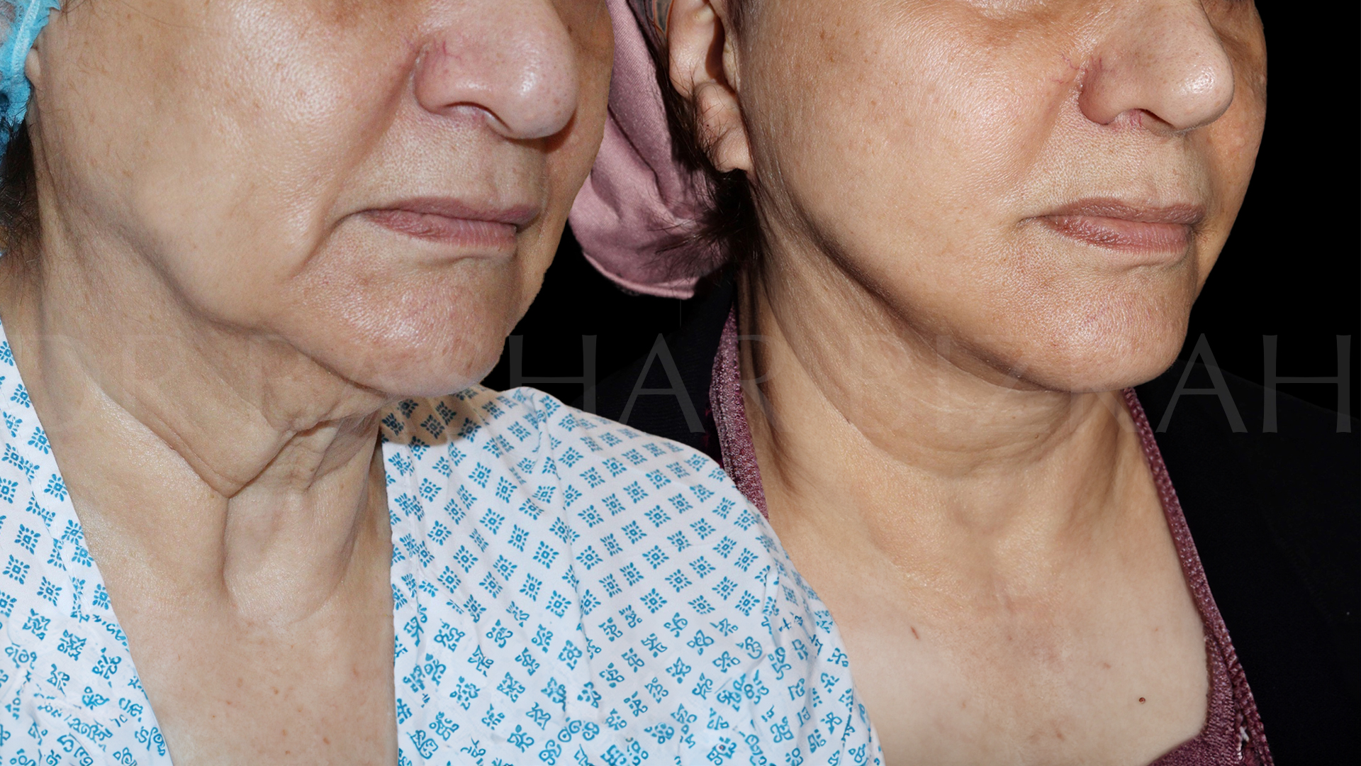 Facelift B&A (10)