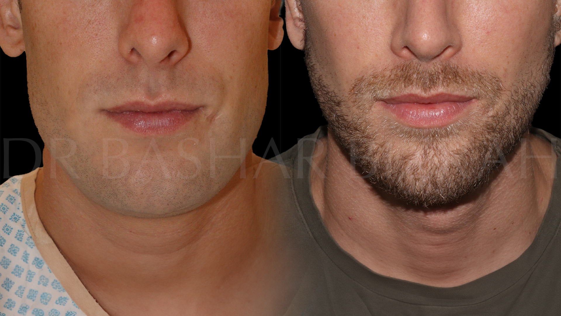 Facelift B&A (12)