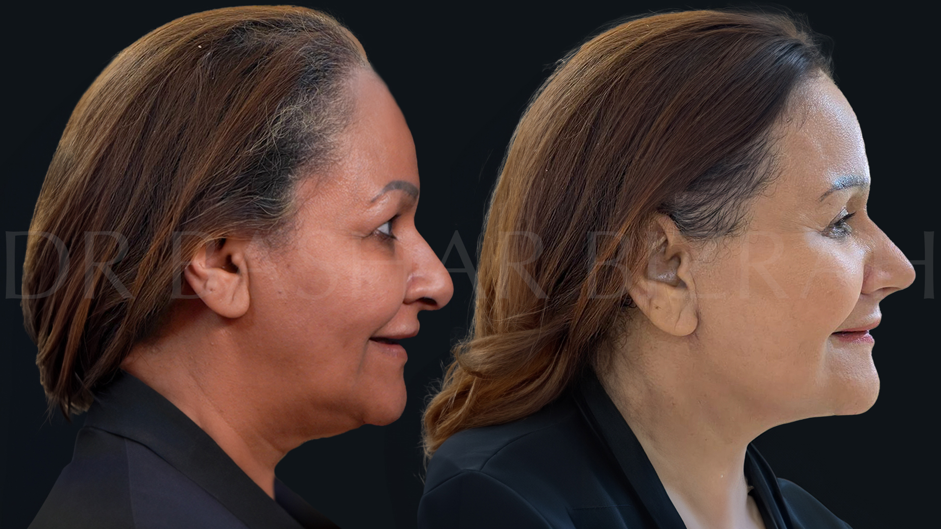 Facelift B&A (13)