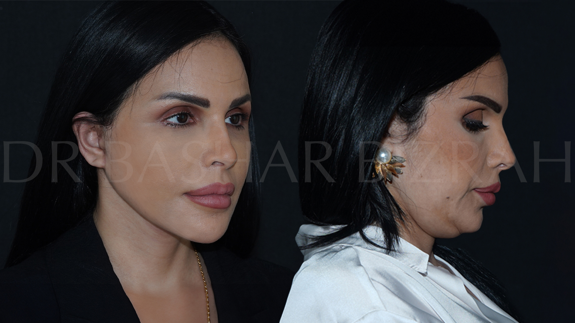 Facelift B&A (14)