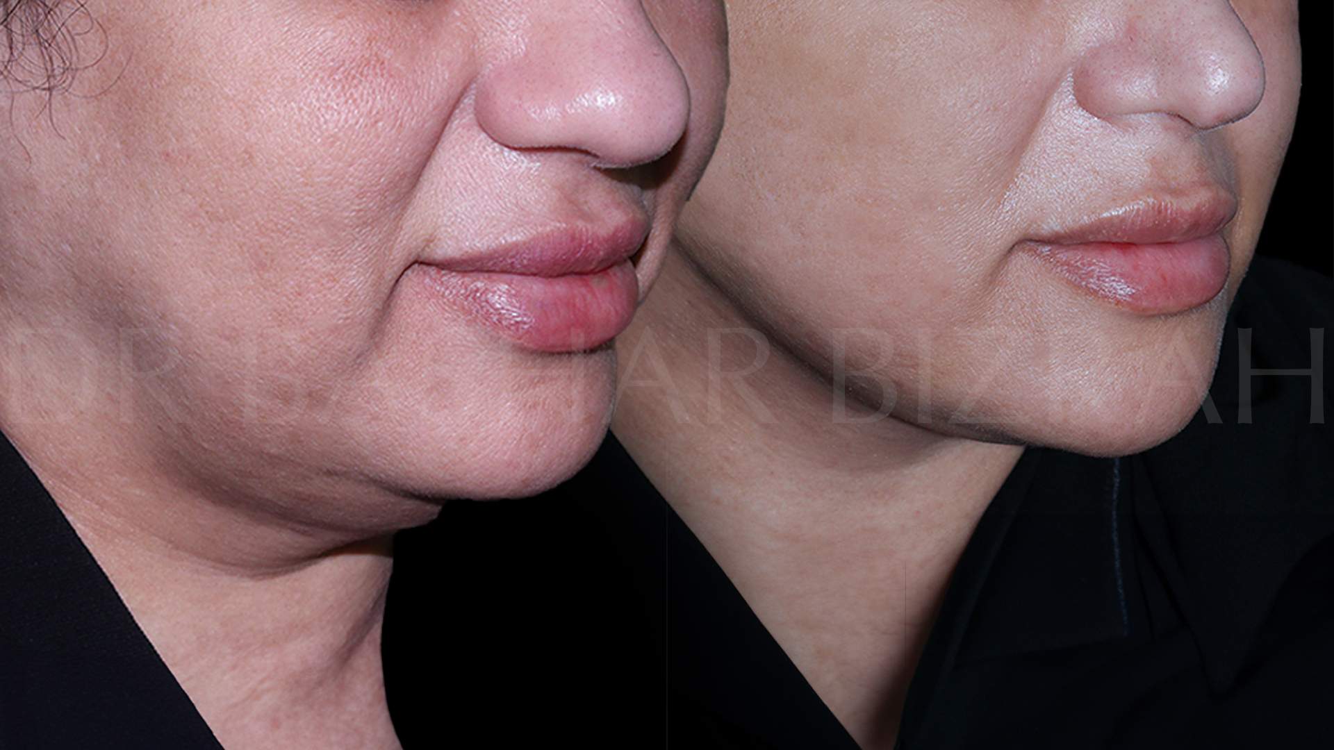 Facelift B&A (15)