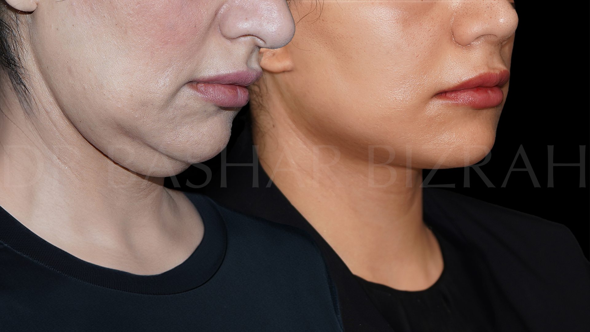 Facelift B&A (2)
