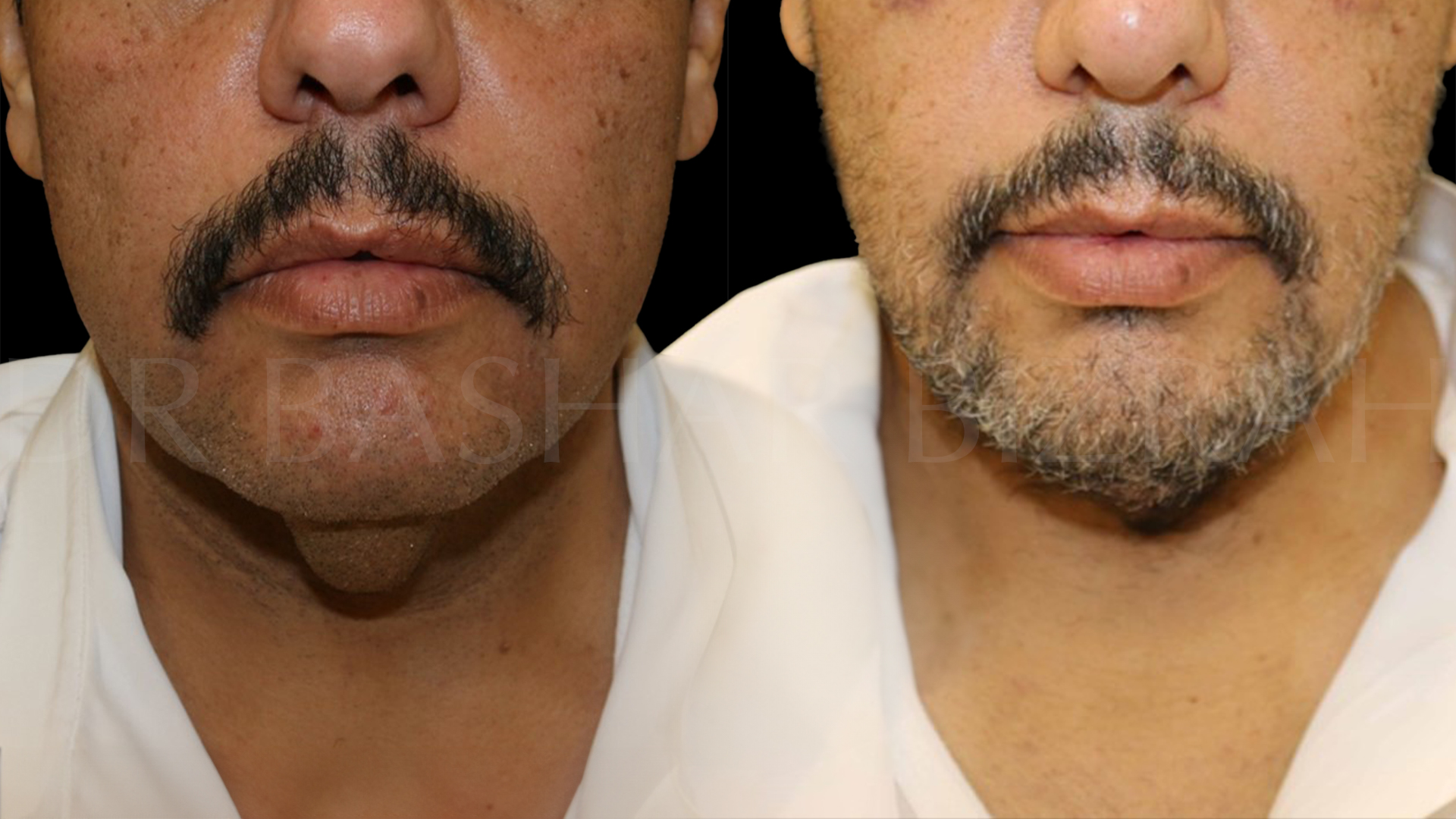 Facelift B&A (3)