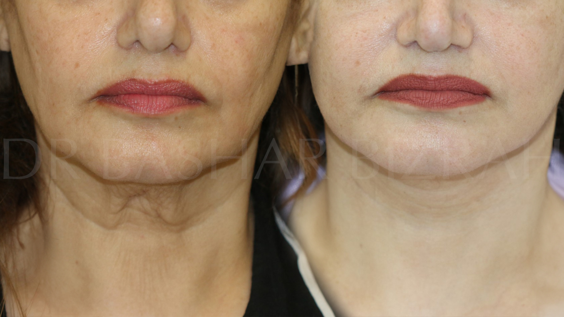 Facelift B&A (4)
