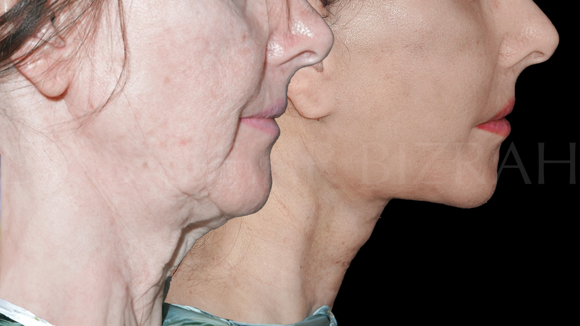 Facelift B&A (5)