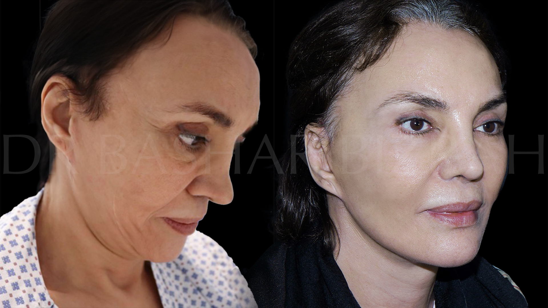 Facelift B&A (6)