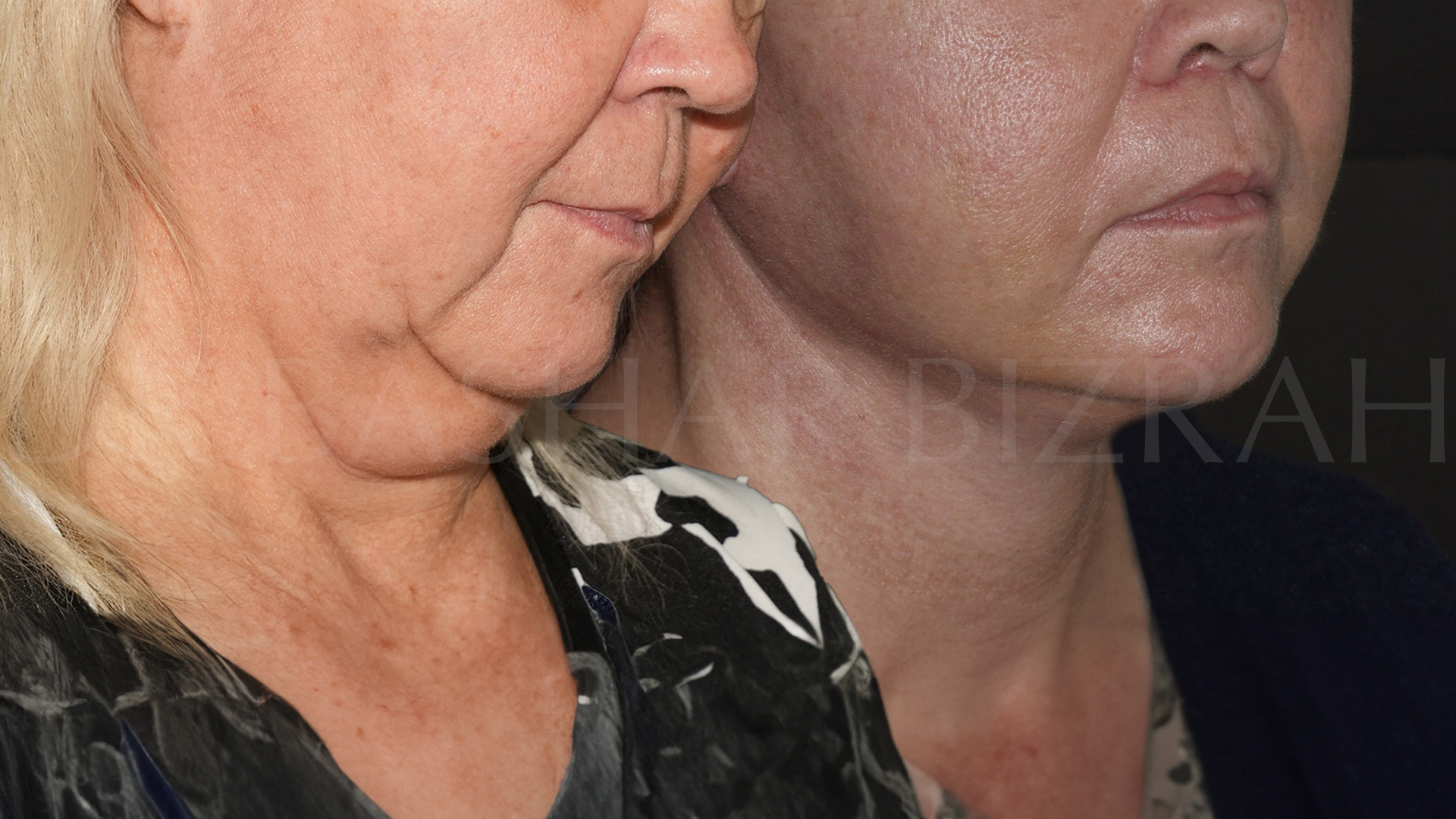 Facelift B&A (7)