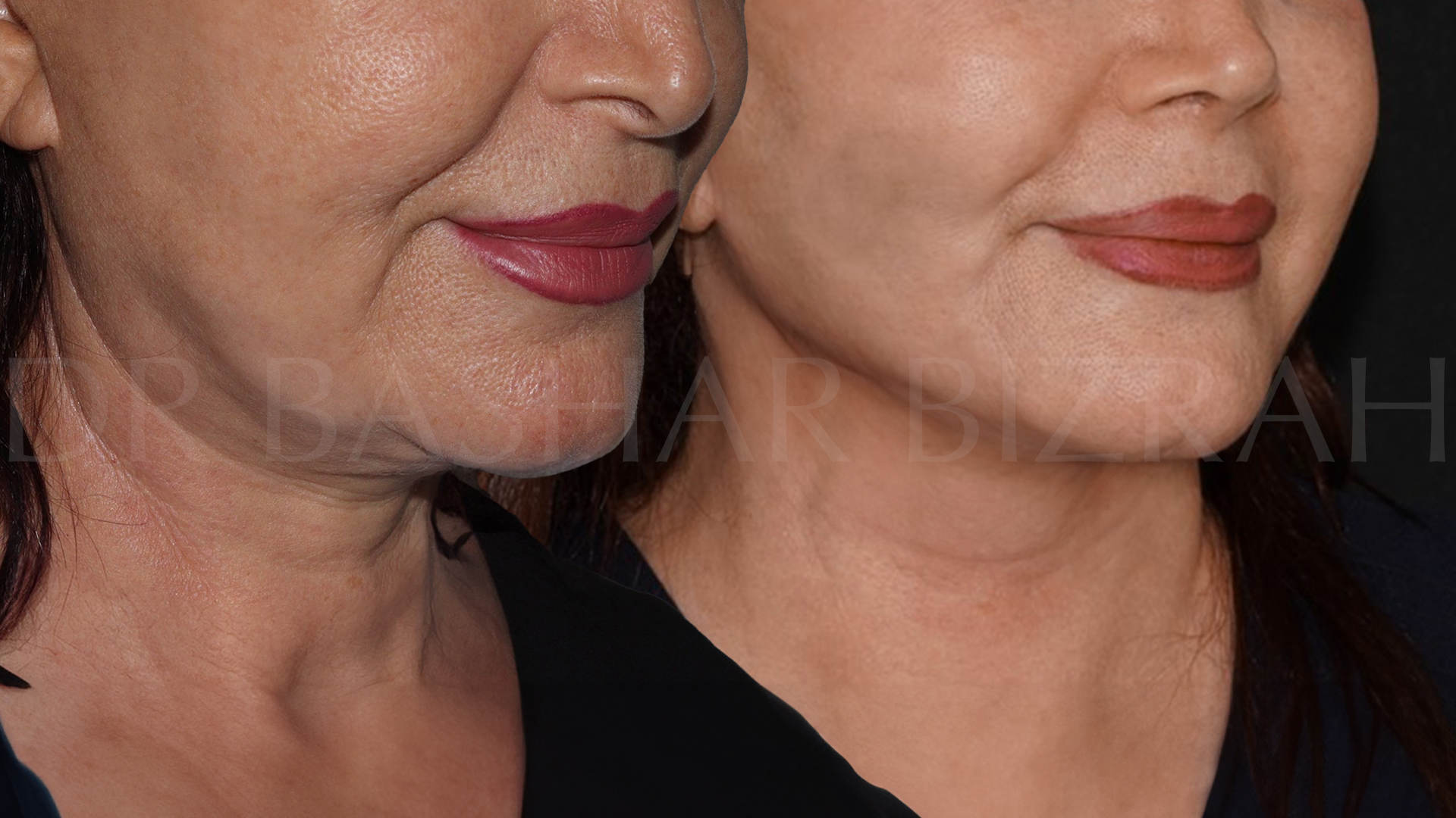 Facelift B&A (8)