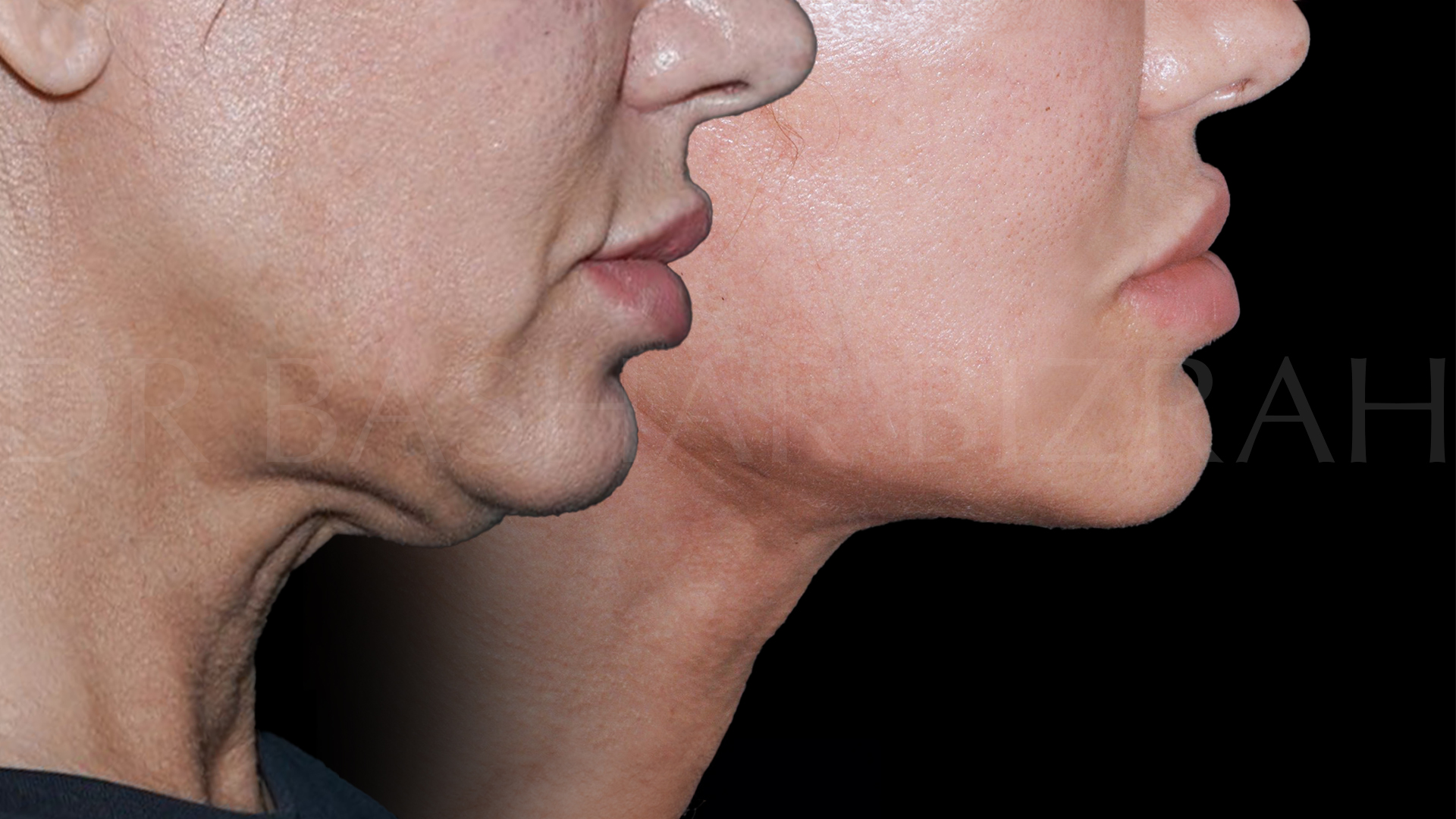 Facelift B&A (9)