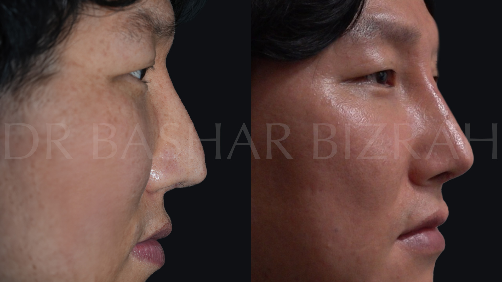 Korean_Rhinoplasty