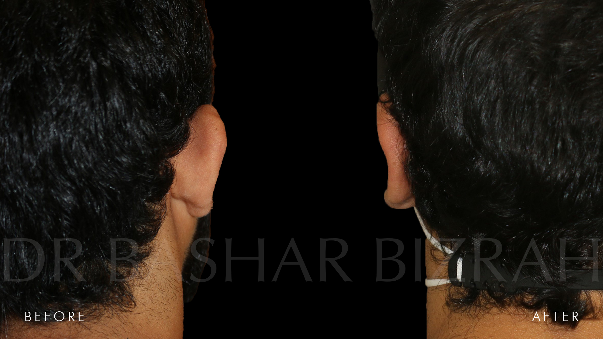 Otoplasty B&A (1)
