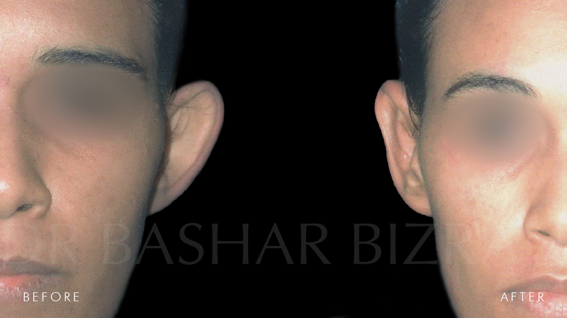 Otoplasty B&A (2)
