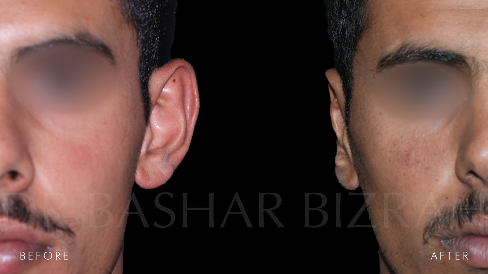 Otoplasty B&A (3)
