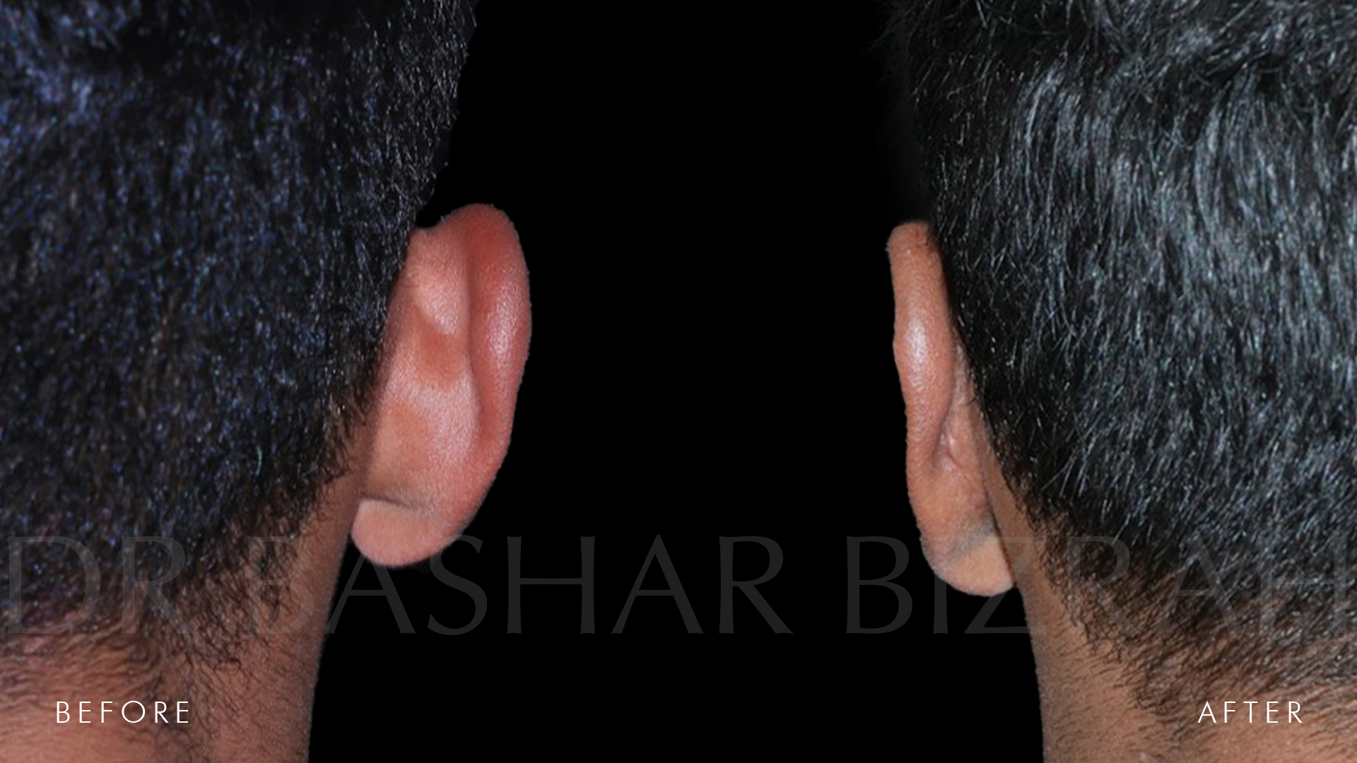 Otoplasty B&A (4)