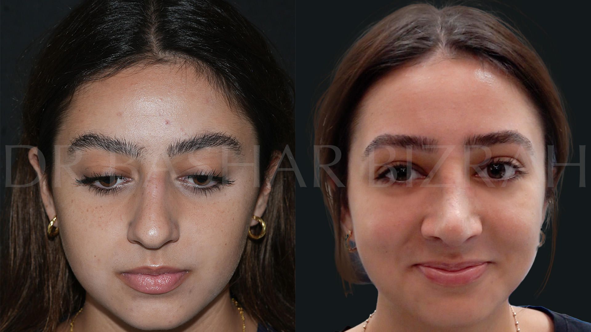Rhinoplasty (1)