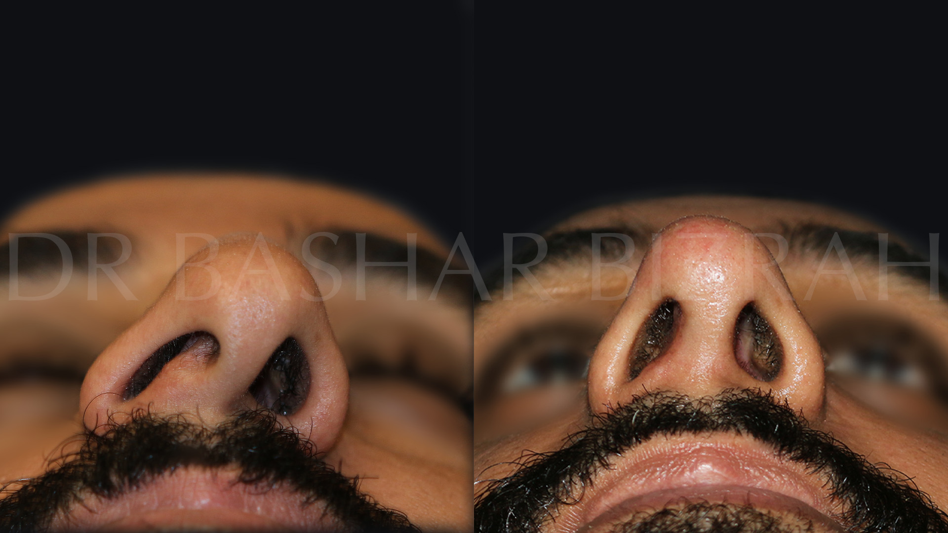 Rhinoplasty (10)