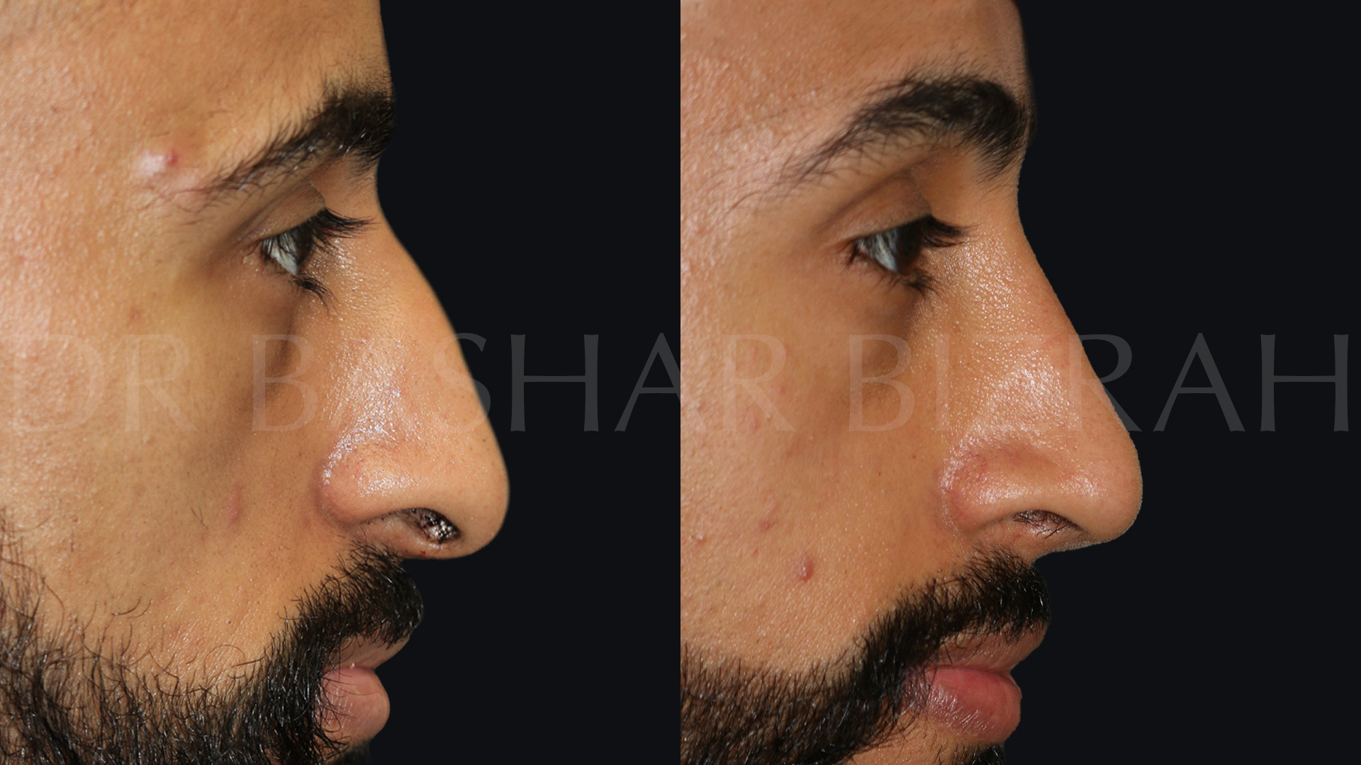 Rhinoplasty (11)