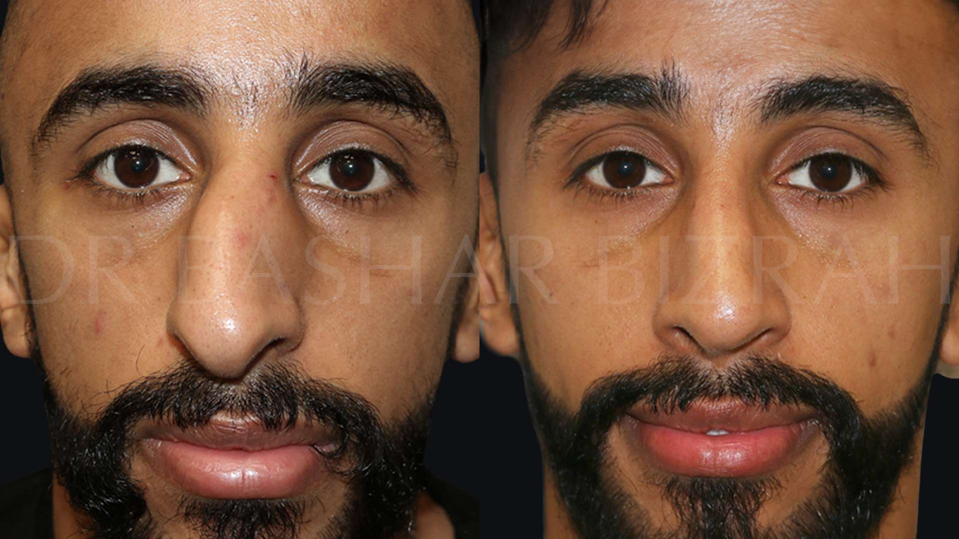 Rhinoplasty (12)