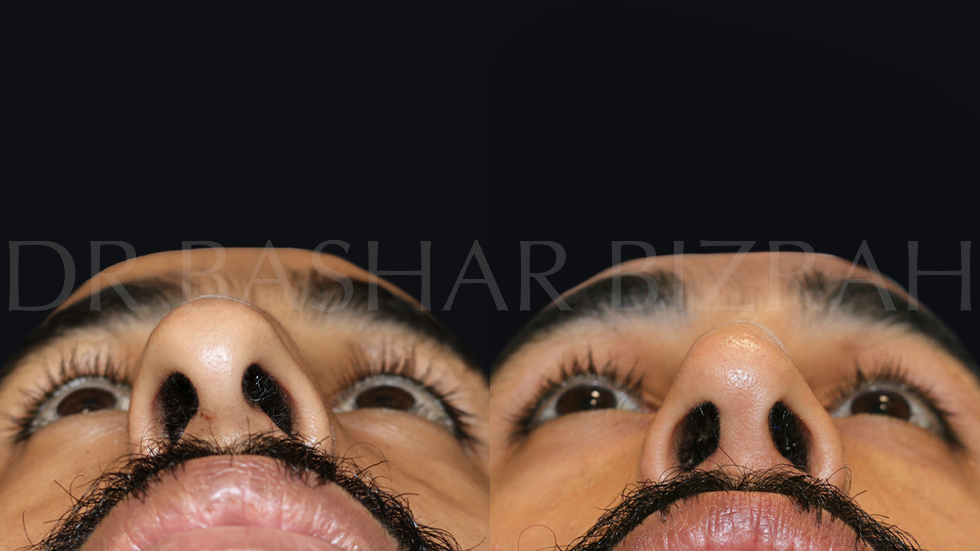 Rhinoplasty (13)