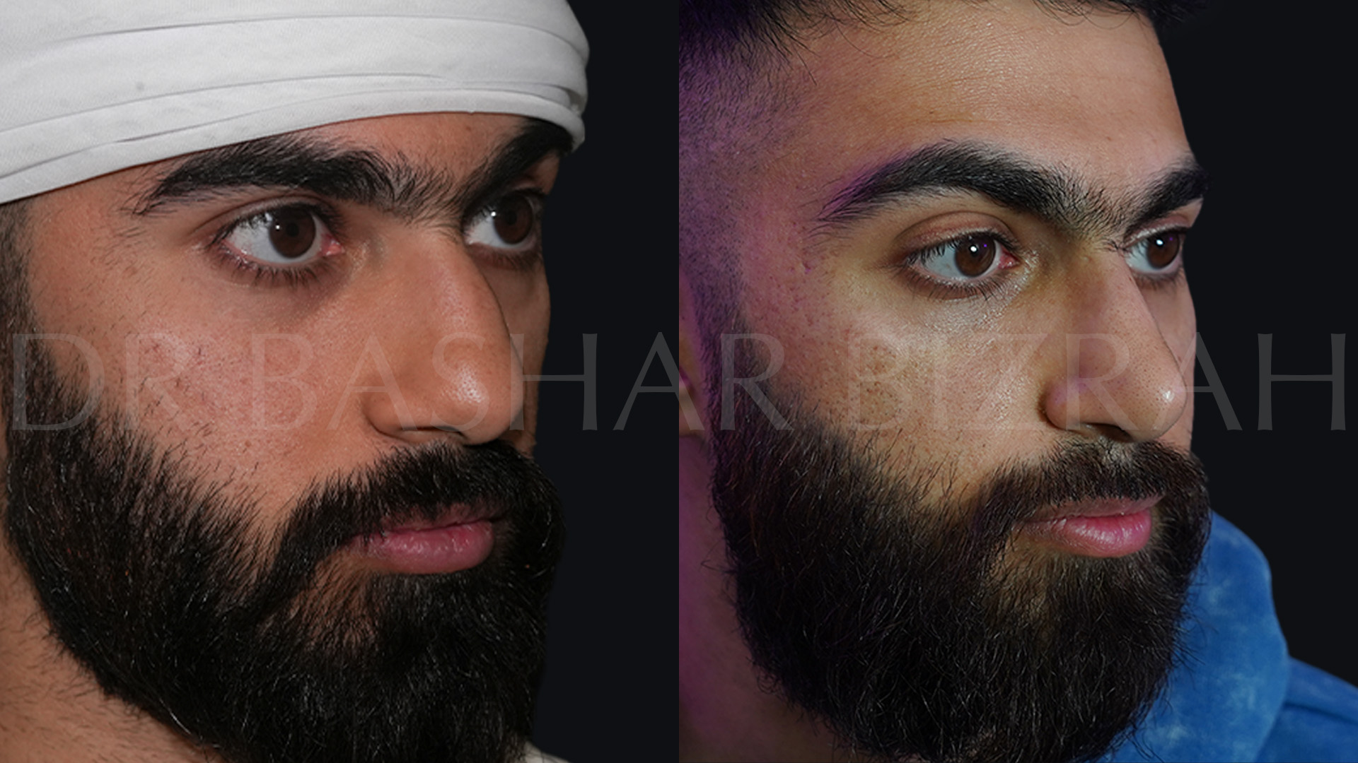 Rhinoplasty (14)