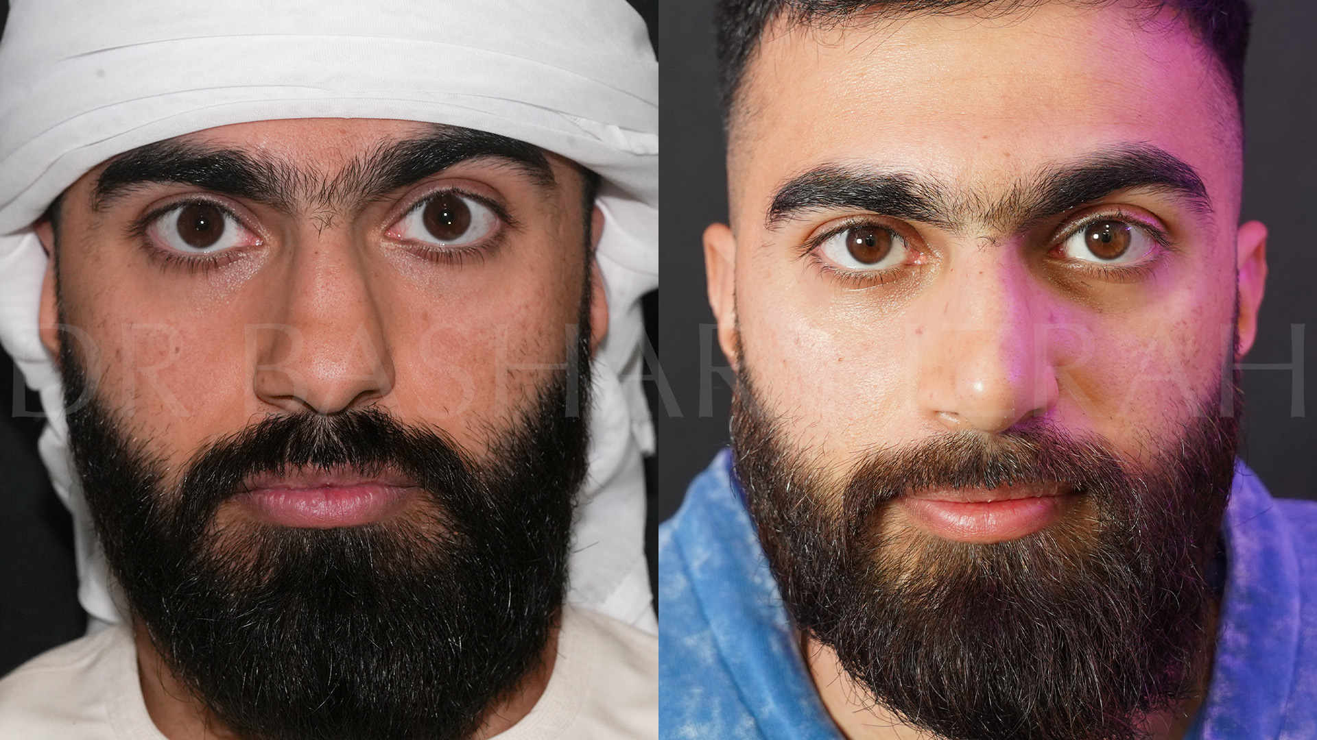 Rhinoplasty (15)