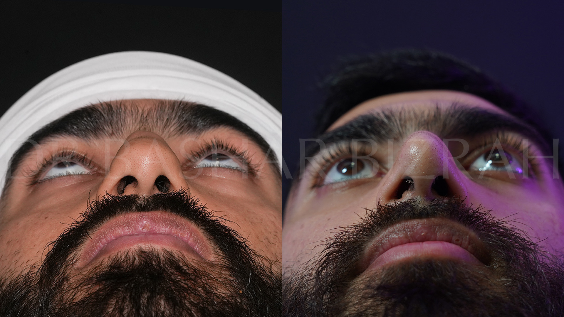 Rhinoplasty (16)