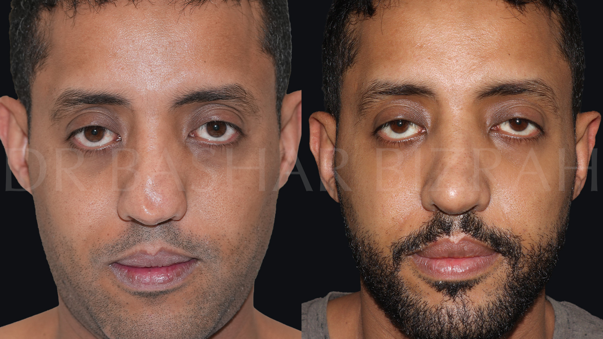 Rhinoplasty (17)
