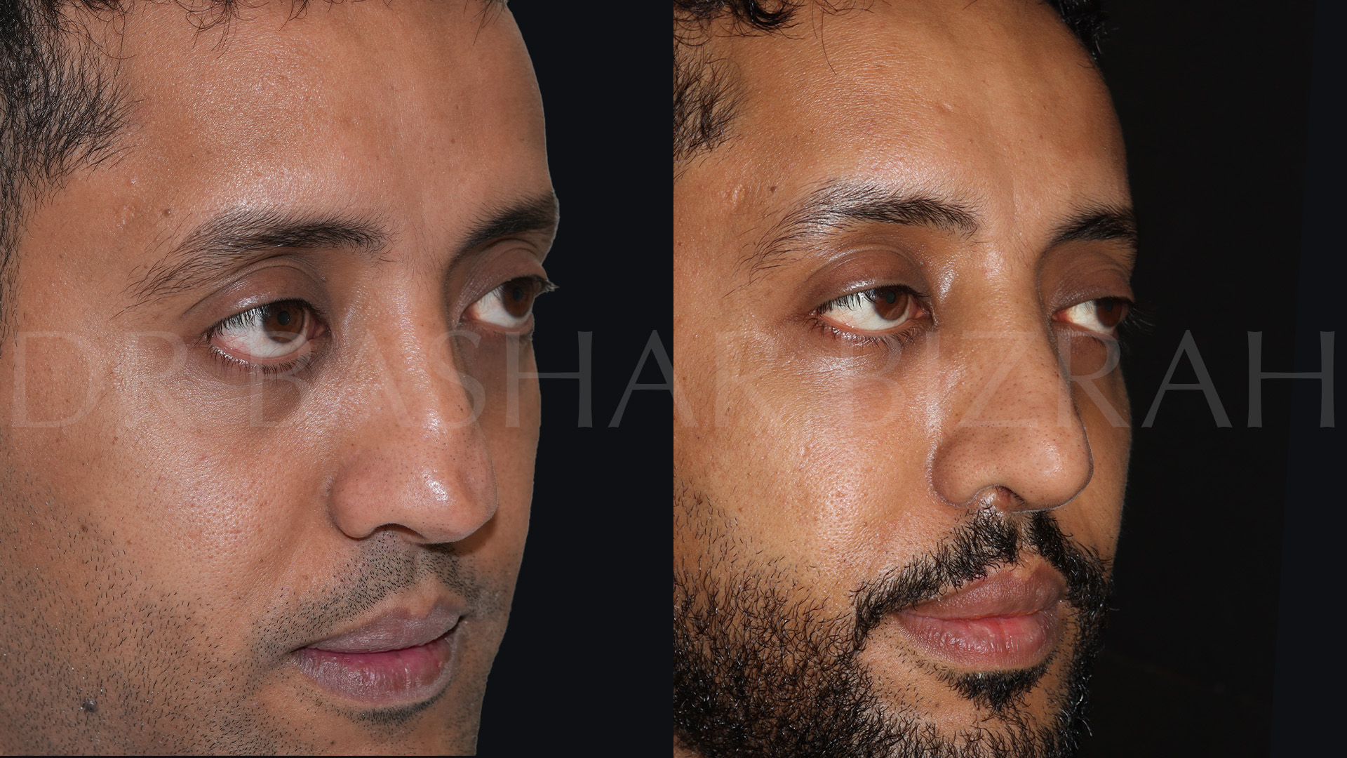 Rhinoplasty (18)