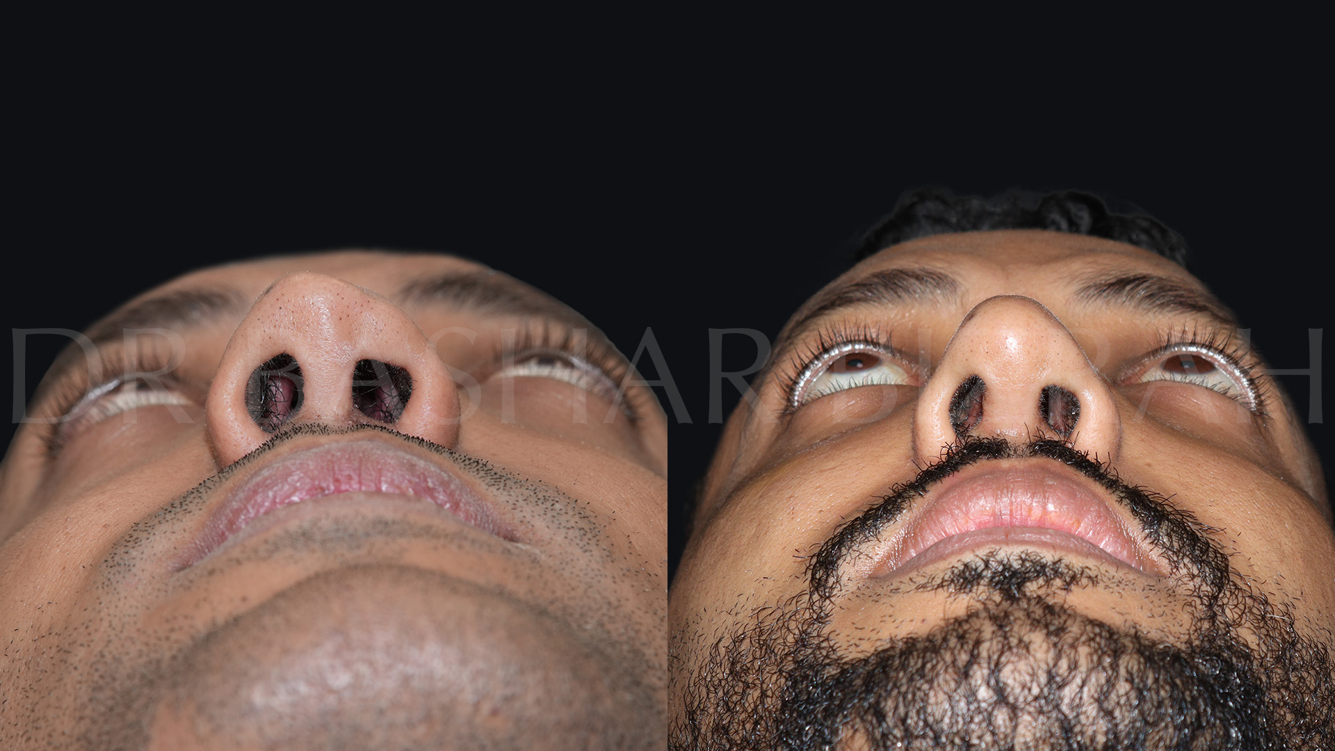 Rhinoplasty (19)