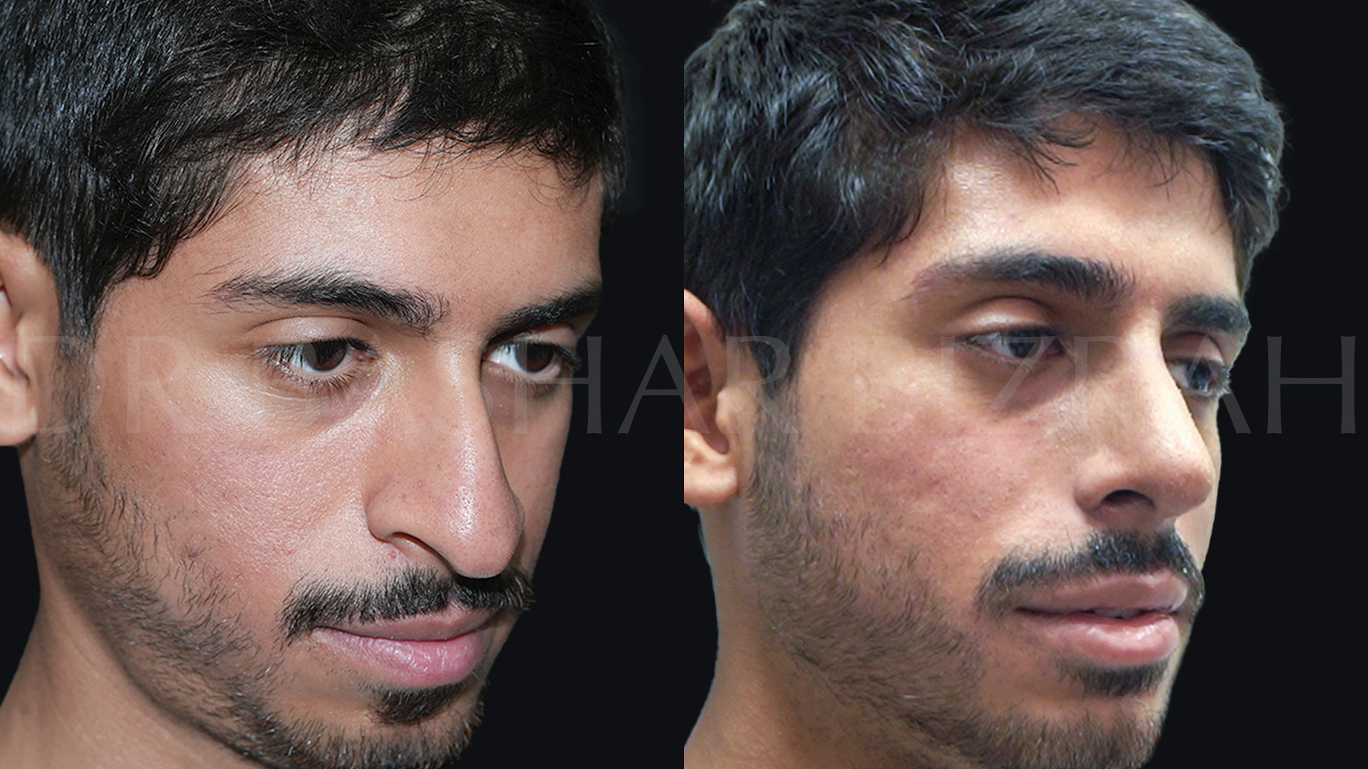 Rhinoplasty (2)