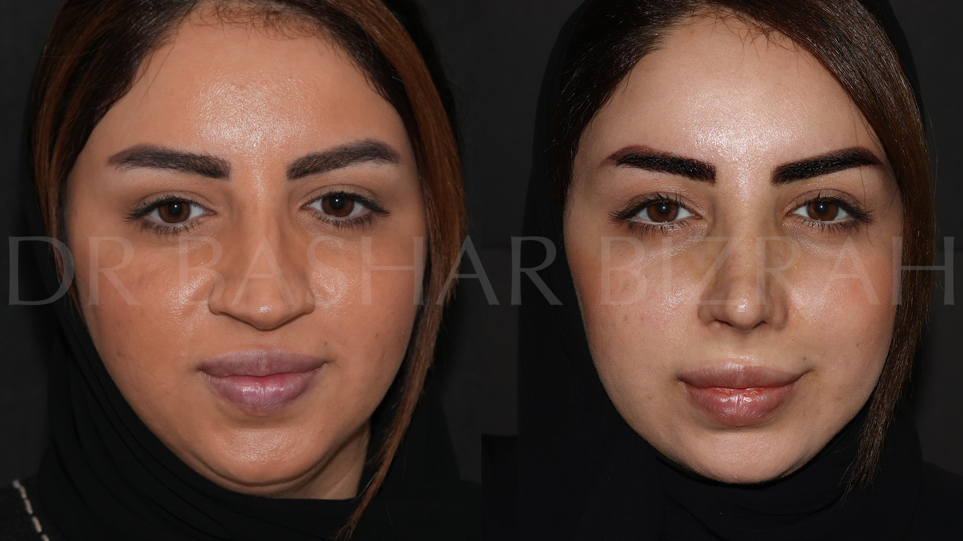 Rhinoplasty (20)