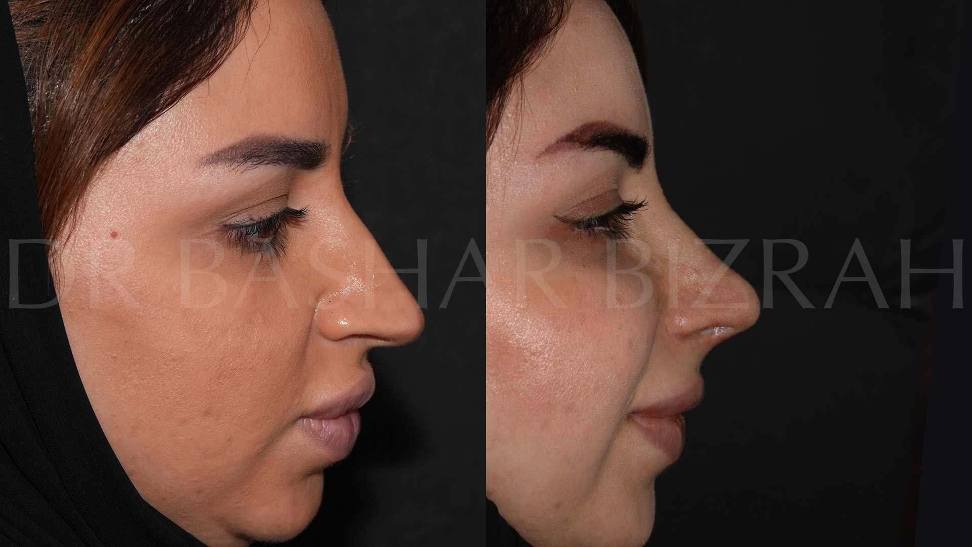 Rhinoplasty (21)