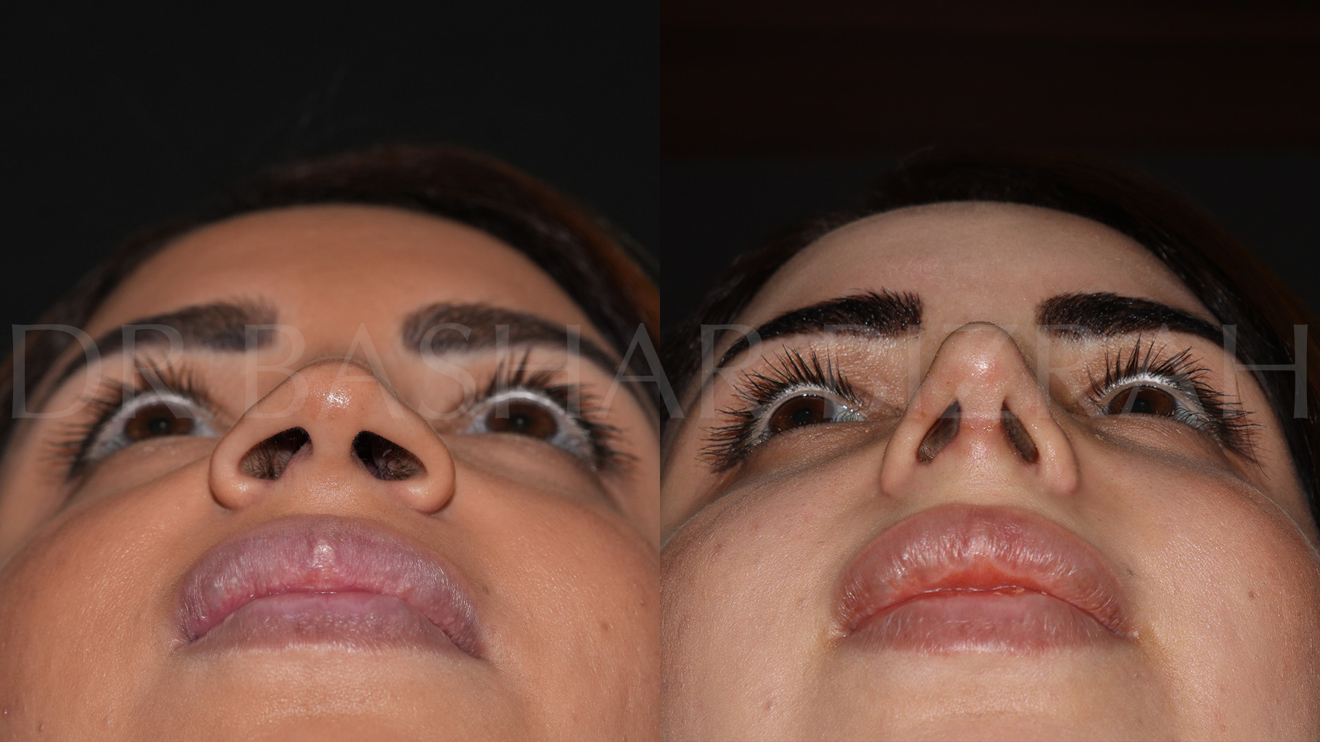 Rhinoplasty (22)