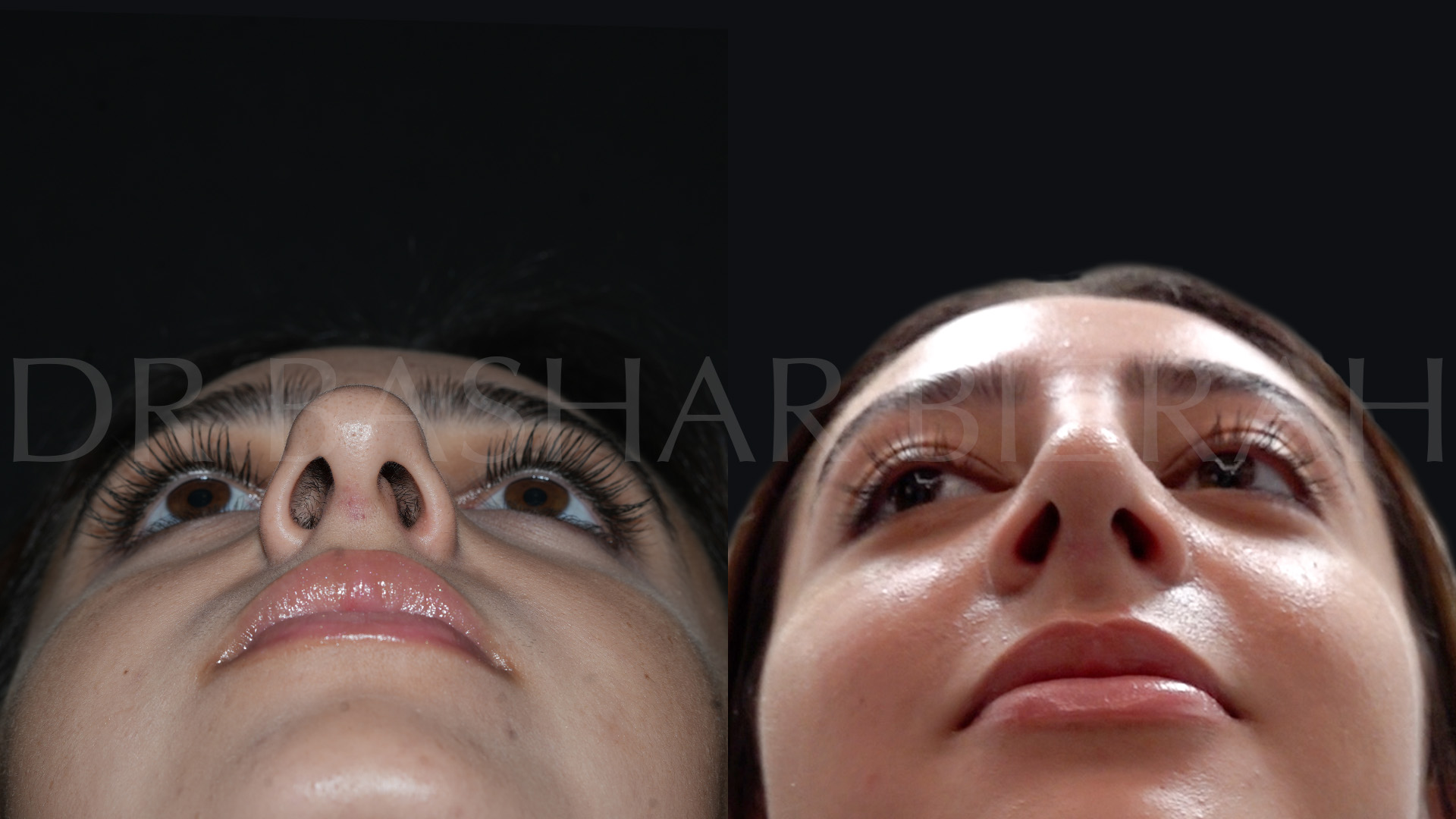 Rhinoplasty (23)