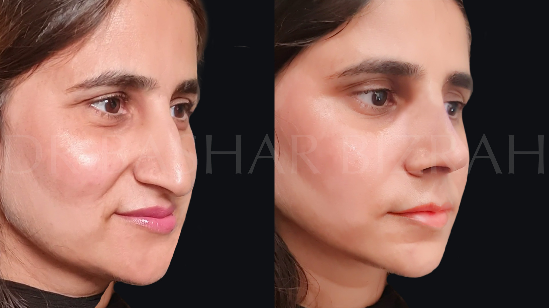 Rhinoplasty (24)