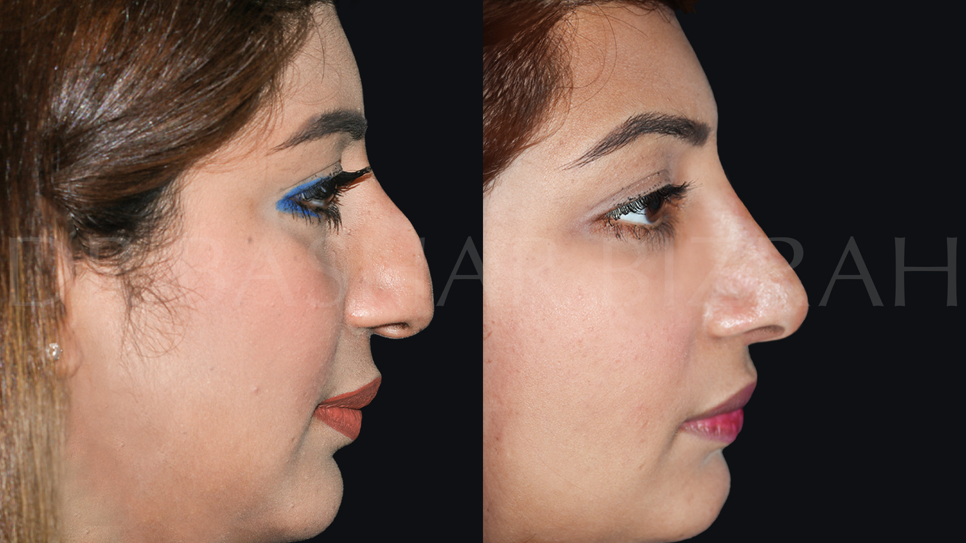 Rhinoplasty (25)