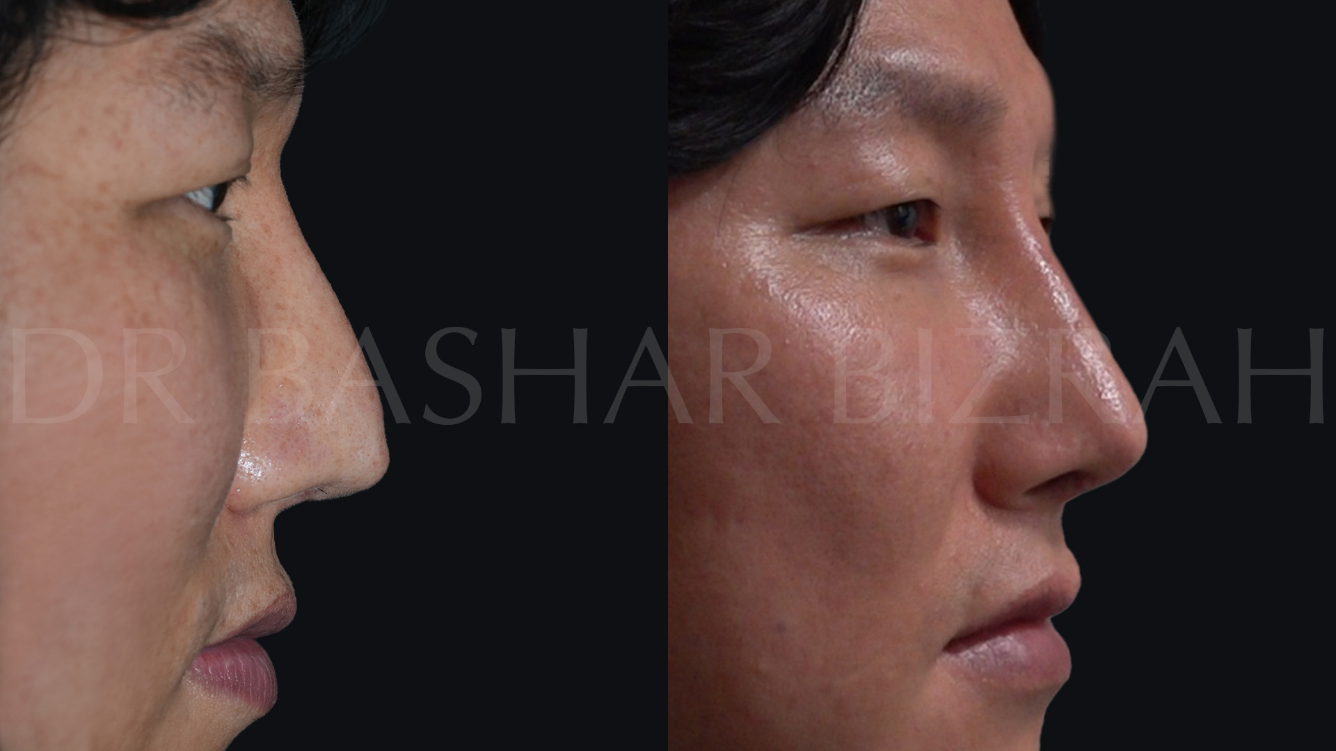 Rhinoplasty (26)