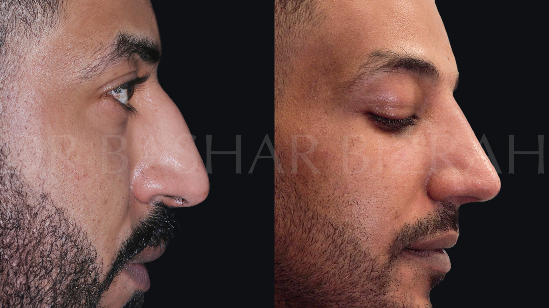 Rhinoplasty (29)