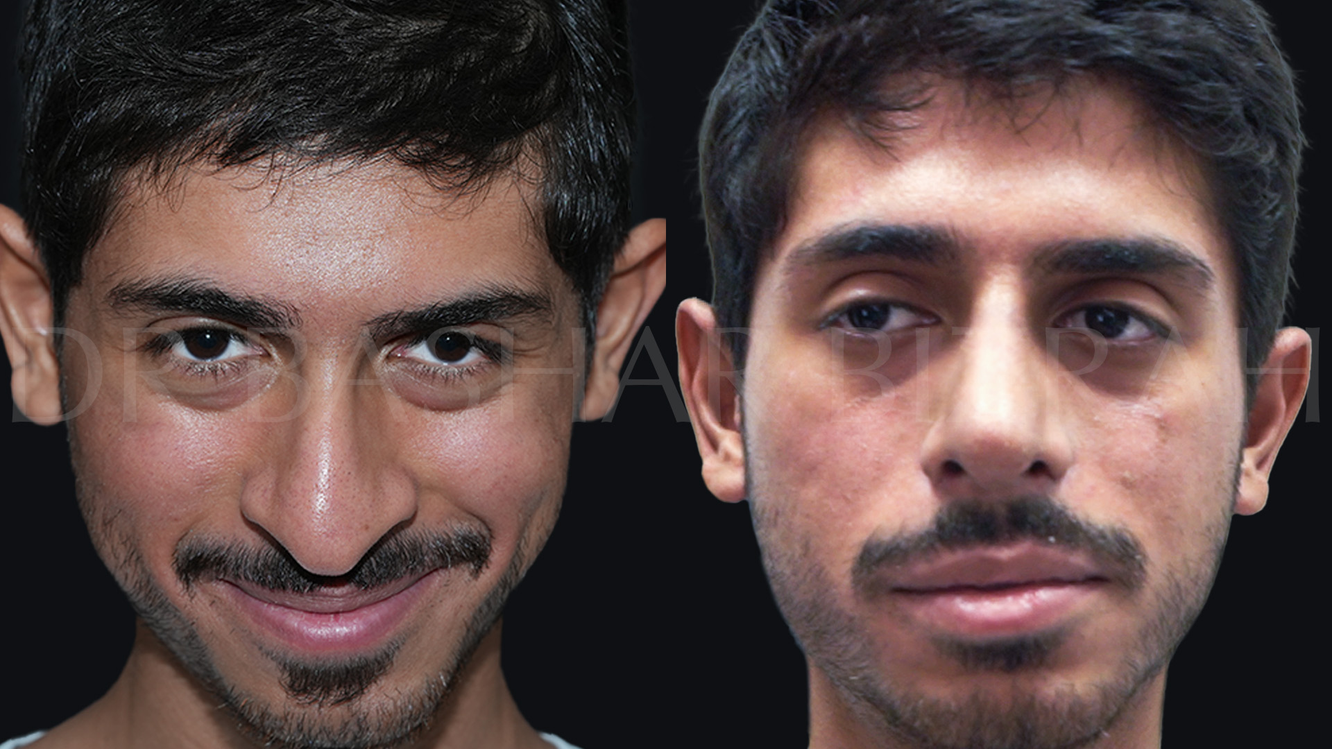 Rhinoplasty (3)