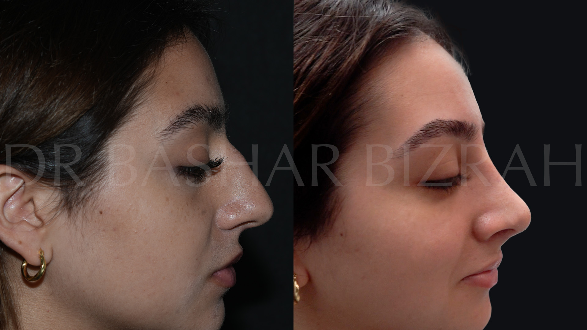 Rhinoplasty (30)